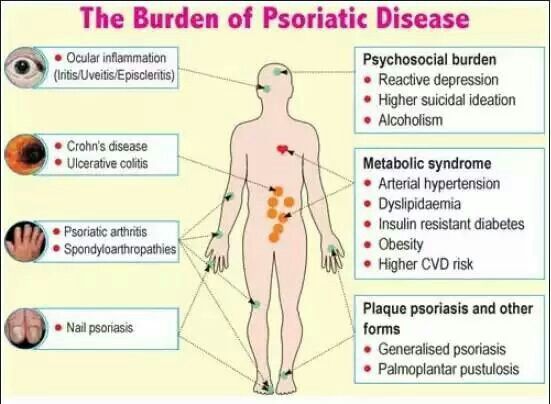 plaque psoriasis and psoriatic arthritis