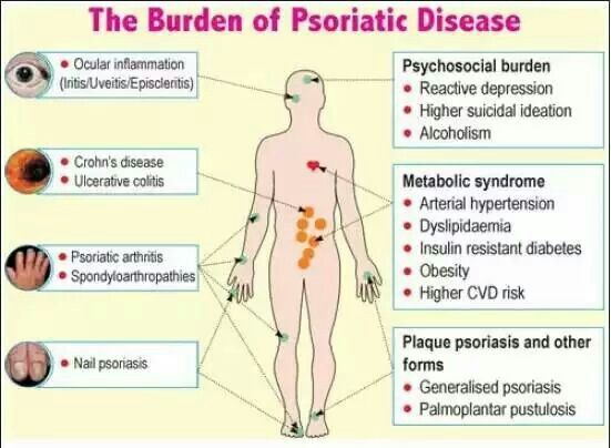 Psoriasis és arthrosis